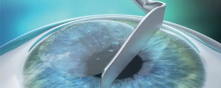 Advanced Surface Ablation (PRK, Epi-LASIK, LASEK, TransPRK)
